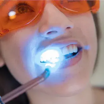 ¿Los blanqueamientos dentales caseros funcionan?